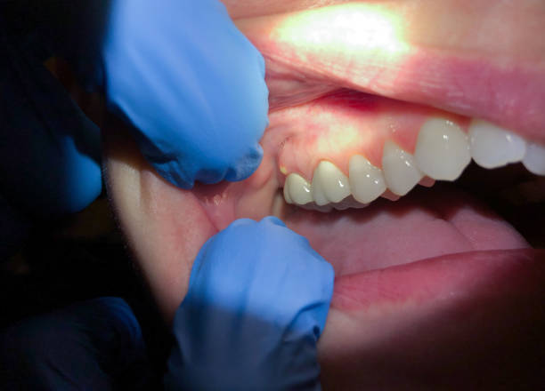 Best Emergency Wisdom Tooth Extraction in Sleepy Hollow, CA